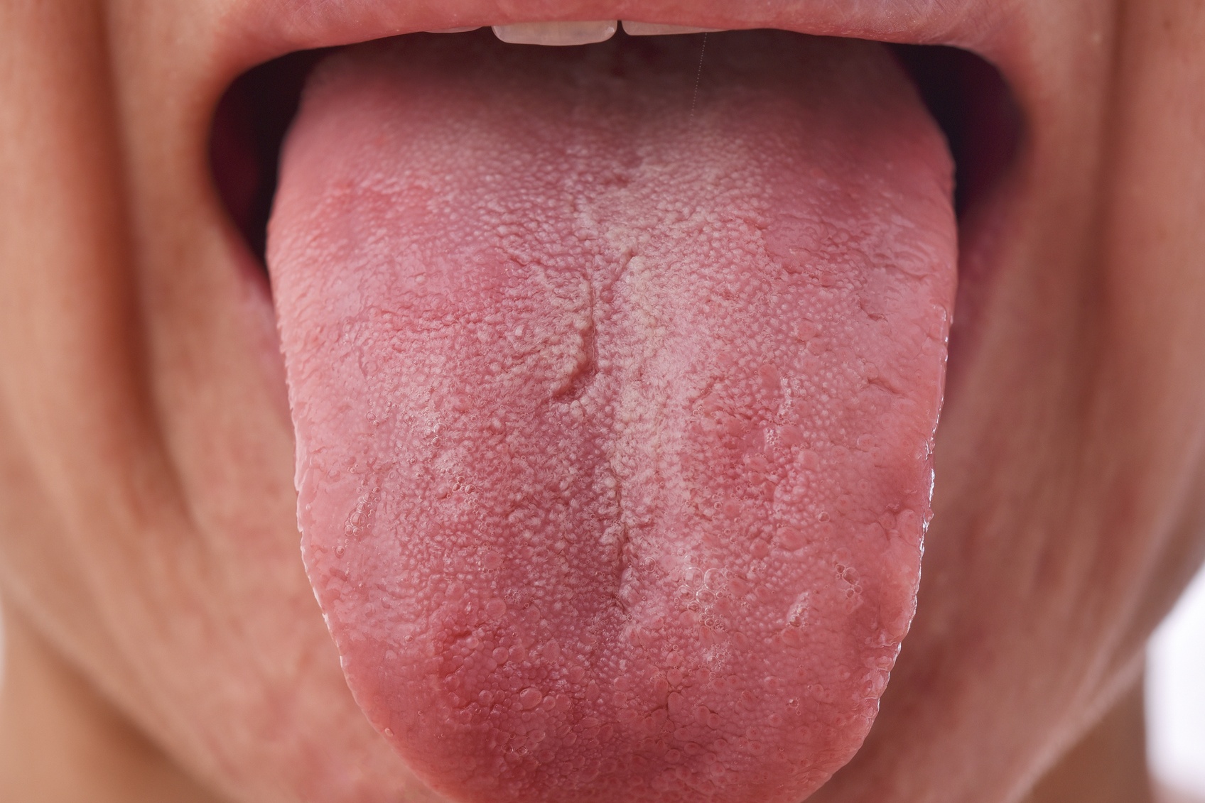Papillomavirus langue traitement Papillomavirus langue